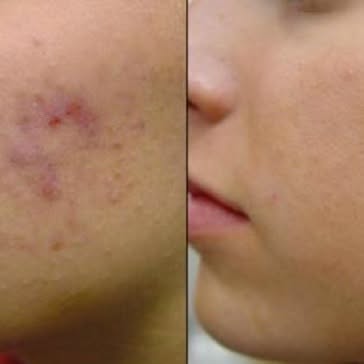 Acne - using Obagi Medical products and C02 laser.
Tel: 01273 738409
Email: shadidanin@shadidanin.co