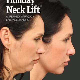 One of the most common concerns I hear is early neck aging — loss of jawline definition, mild laxity