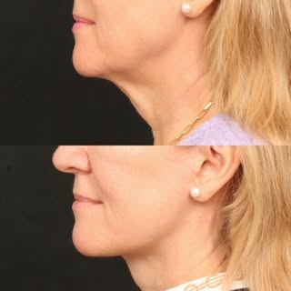 Deep Plane Face & Neck Lift with Fat Transfer and Upper Blepharoplasty 

A refreshed jawline, smooth