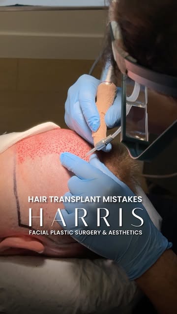 A natural-looking hair transplant starts long before the hair grows in. It starts with the design.

