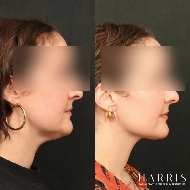 The power of The Holiday Neck Lift®.

A more defined jawline and crisp neck angle—all while maintain