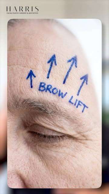 Harmony Facelift vs. Holiday Neck Lift®: which one is right for you?

The difference comes down to w