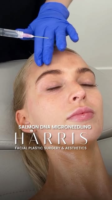Great skin still needs maintenance. Potenza combines RF energy with microneedling to support collage
