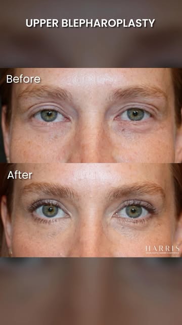 Heavy, tired-looking eyes aren’t always something Botox can fix.

When excess upper eyelid skin star
