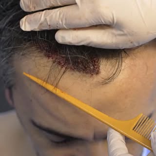 One of the biggest advantages of Long Hair FUE is simple:

You see the result immediately.

Since th