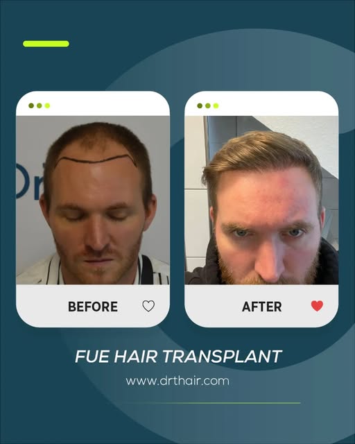 A successful FUE Hair Transplant result with a natural and balanced appearance.

This before and aft