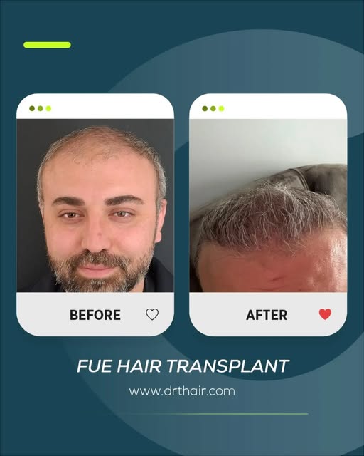 A natural-looking result with FUE Hair Transplant.

This before and after shows how the right planni