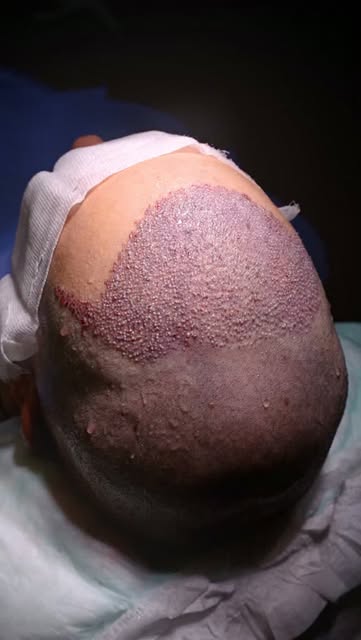 A look at the process immediately after a standard FUE Hair Transplant procedure.

Every graft is pl