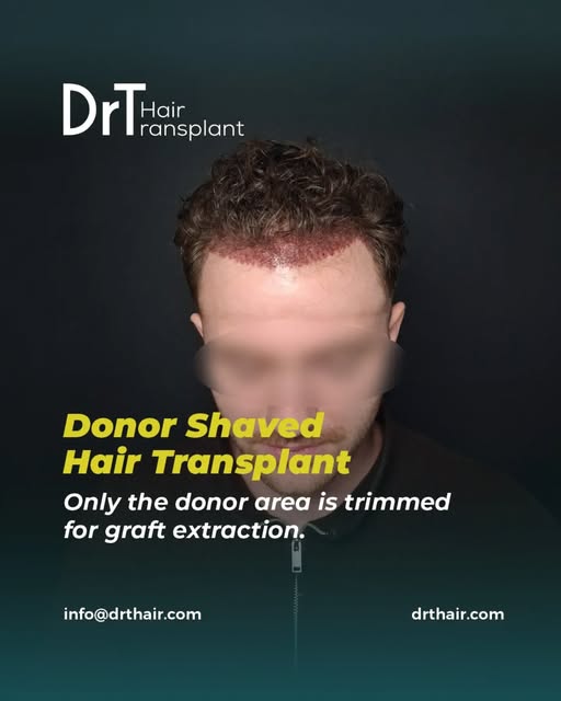 How much hair needs to be shaved for a hair transplant?

With a donor shaved approach, only the requ