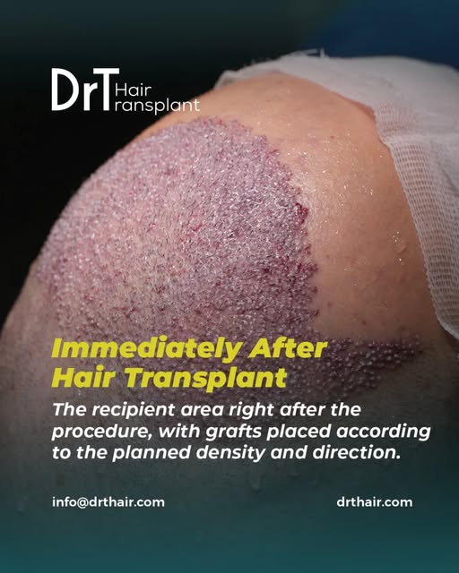 A closer look at the recipient area immediately after a hair transplant procedure.

Every graft is p