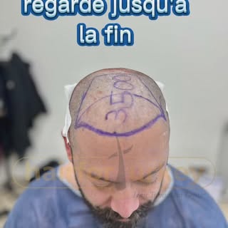 Clinique capillaire casablanca Morocco

#hairforturkey #instahair #hairstyles #haircut #injentocapil