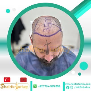 ‎أخصائيو زراعة الشعر الان في الدار البيضاء 🇹🇷🇲🇦
📍 Casablanca
‎يمكنكم الإستفادة من  التخفيضات ال