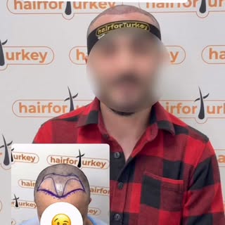 ⁨	⁨	“شاهد لحظات زراعة الشعر من داخل عيادتنا في الدار البيضاء
فريق طبي متخصص، نتائج دائمة، ومظهر طبيع