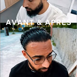 Greffe De Cheveux 📍Casablanca

“Chouf l’far9 qbl w b3d zra3 dyal ch3r! Lنتيجة kayna amazing w lثقة 