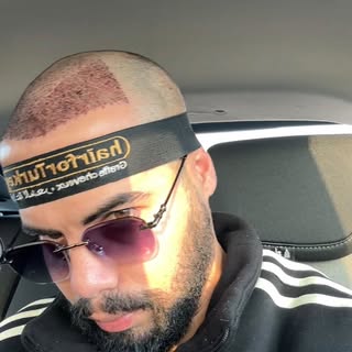 تجربة زراعة الشعر في المغرب 🇲🇦🇹🇷

#الدار_البيضاء #المغرب #مراكش #الرباط 
#casablanca