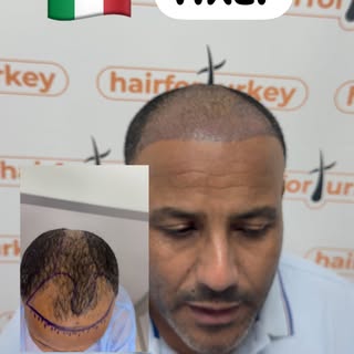 HairforTurkey
✨ Chaque transformation commence par une décision.

Aujourd’hui, nous partageons bien 