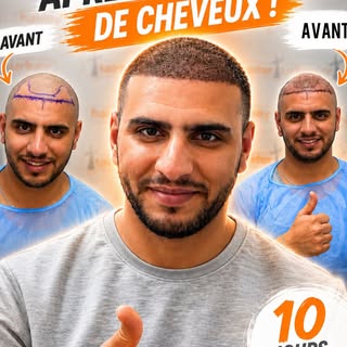 Greffe de Cheveux Casablanca – Résultat Après 10 Jours | FUE & DHI

Voici l’évolution de notre patie