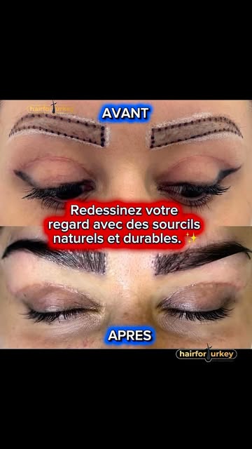 🔥 DES SOURCILS PLUS DENSES ? C’EST POSSIBLE ! 🔥

✨ Transformez vos sourcils grâce à la greffe de s