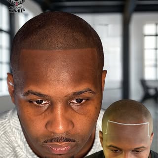 “Do I need to be completely bald to have scalp micro-pigmentation work for me?” 🤔 Absolutely not. A