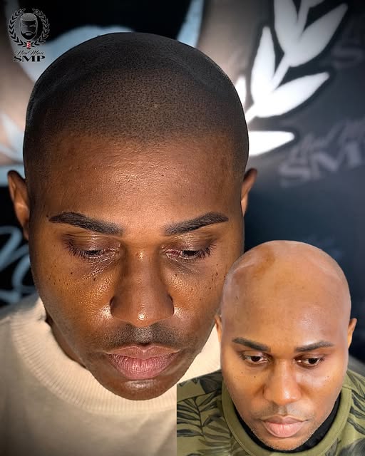 ⭐️Why hairline design matters⭐️
The hairline makes or breaks the result. A strong SMP result starts 