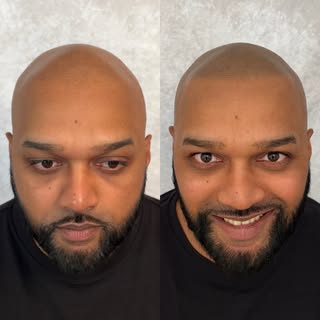 Them 2nd session smiles 😊 @folicule 16 delusion @bishopsmp 04 needles, and SMP power wand #baldhead