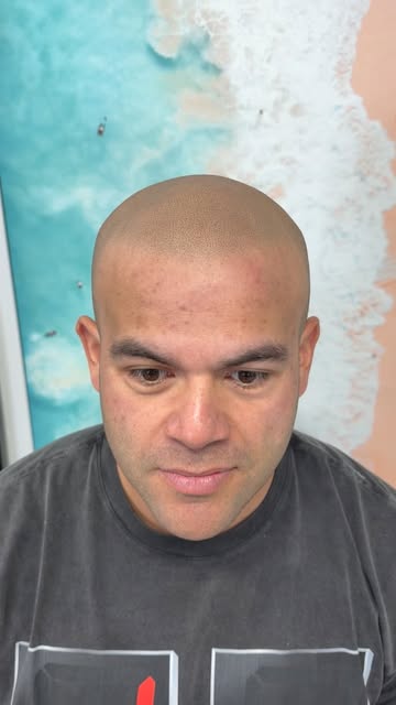 @derekbogs with the hairline fix up 

#scalpmicropigmentation #hairtattoo #scalptattoo