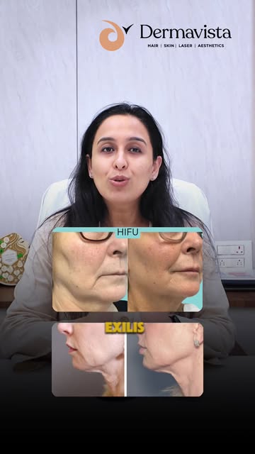 HIFU vs EXILIS- Same goal, different technology.

Skin tightening ke liye har treatment ek jaisa nah