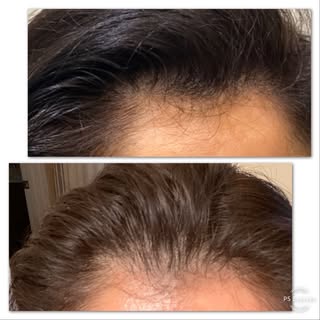 Try SMP for woman . Scalp micro pigmentation in a safe sterile environment.  #smp #scalptattoo #hair