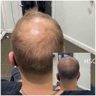 Before and after healed first session scalp micro pigmentation . #smp #scalptattoo #hairtattoo #hair