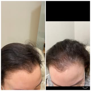 Scalp micro pigmentation for thinning hair  #thinhairsolution #scalpmicropigmentation #hairlosswomen