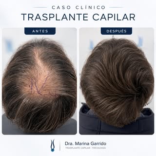 CASO CLÍNICO | TRASPLANTE CAPILAR

Os mostramos la evolución de un paciente tras un trasplante capil