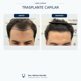 ✨ Trasplante capilar en Barcelona · 3100 UF · Técnica FUE Zafiro

3100 UF para la reconstrucción de 