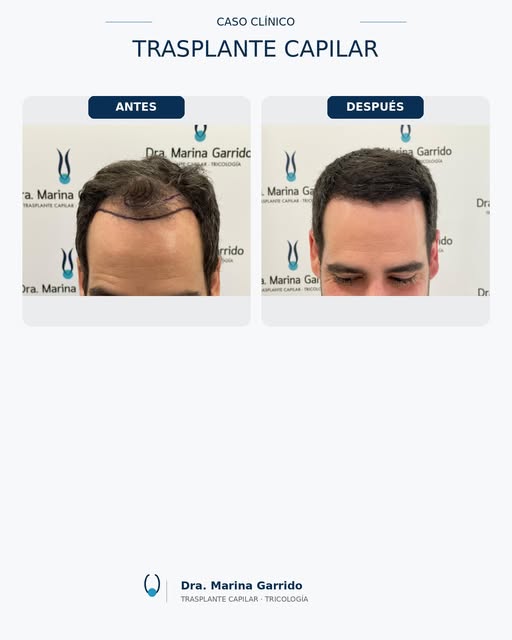 ✨ **9 meses de evolución tras un trasplante capilar FUE Zafiro**

En este caso, el objetivo fue trab