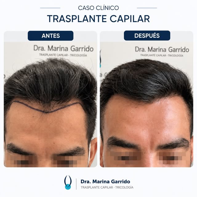 12 meses de evolución | Trasplante capilar FUE Zafiro

Reconstruir las entradas no significa simplem