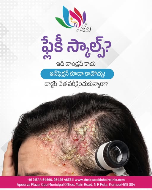 🧴 తలపై పొరలు వస్తున్నాయా? ఇది కేవలం చుండ్రు కాకపోవచ్చు! ⚠️

తలపై పొరలు, దురద కనిపిస్తే చాలామంది వెం