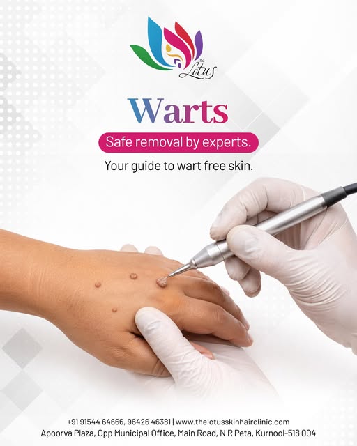 ✨ Warts? It's Time for Wart-Free Skin!

Warts can be unwanted and uncomfortable, but professional ev