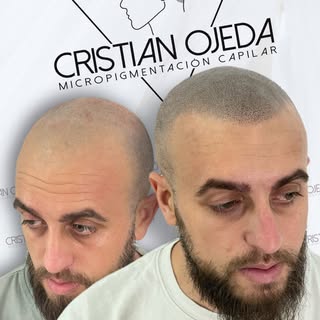 🎯 Objetivo: Confianza Total
💥 Resultado: Micropigmentación Capilar 💥

¿Quién dijo que los cambios