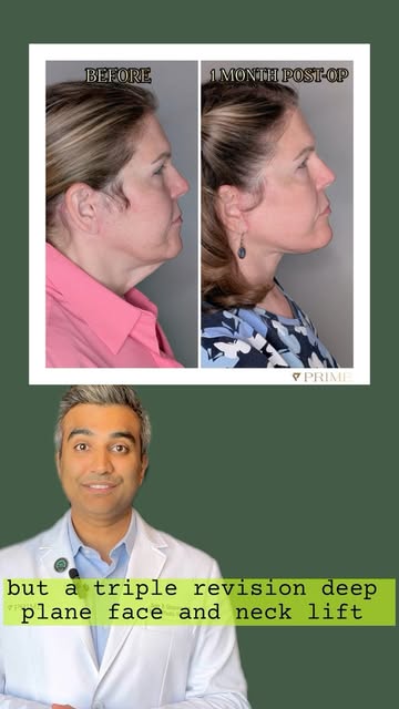 A third revision facelift requires a thoughtful, highly customized approach.
After undergoing two pr