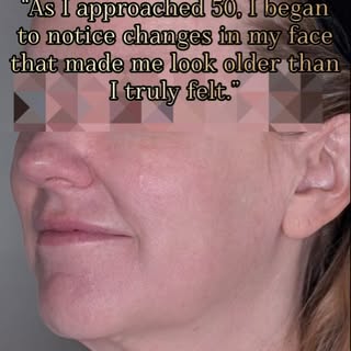 Our patient has had a long journey and officially reached her 1 year mark post Deep Plane Face/Neck 