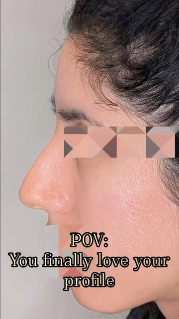 Our patient is 3 months out from her rhinoplasty and is loving the results! Check back in at the 6 m