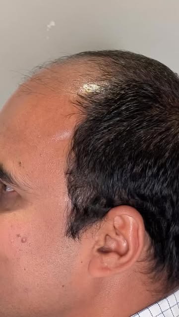 6 months later, and his hairline is making a comeback! 👀

Our patient is officially 6 months post-h