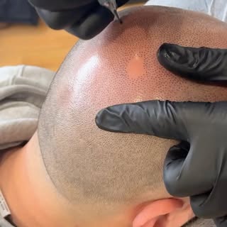 1st Session finish line 🏁  @scalpmicro_usa  #scalpmicrousa #baldhead #smphairtattoo #smp #scalpmicr