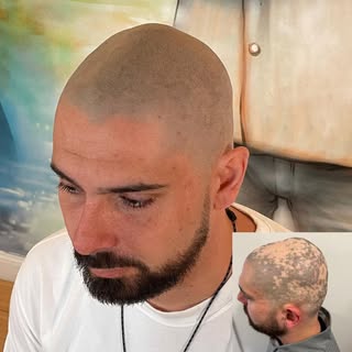 If you’re suffering from alopecia, SMP is the #1 solution.. 💥 #scalpmicrousa #baldhead #smphairtatt