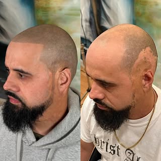 Burn/Scar Concealment + Fresh Hairline/Beard 💈 #scalpmicrousa #baldhead #smphairtattoo #smp #scalpm