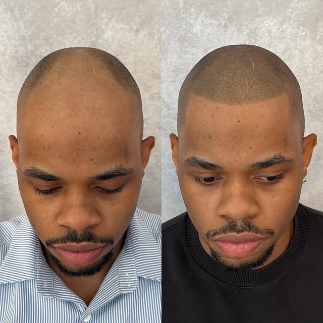 Youthful hair line, and Left the scar for more natural look. 🔥 @folicule 4 delusion @bishopsmp 04 n