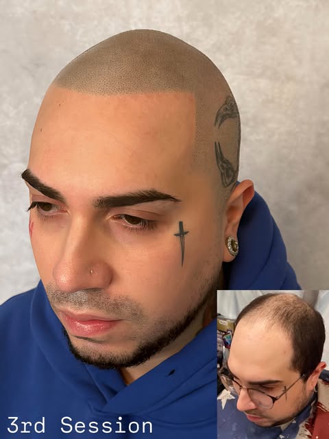 3rd Session results 🔥🔥🔥 @folicule 14 delusion @bishopsmp 04 needles, and SMP power wand #baldhead