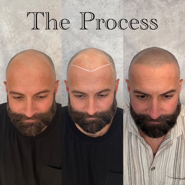 Trust the PROCESS 🔥 @folicule 16 delusion @bishopsmp 04 needles, and SMP power wand #baldhead #smph