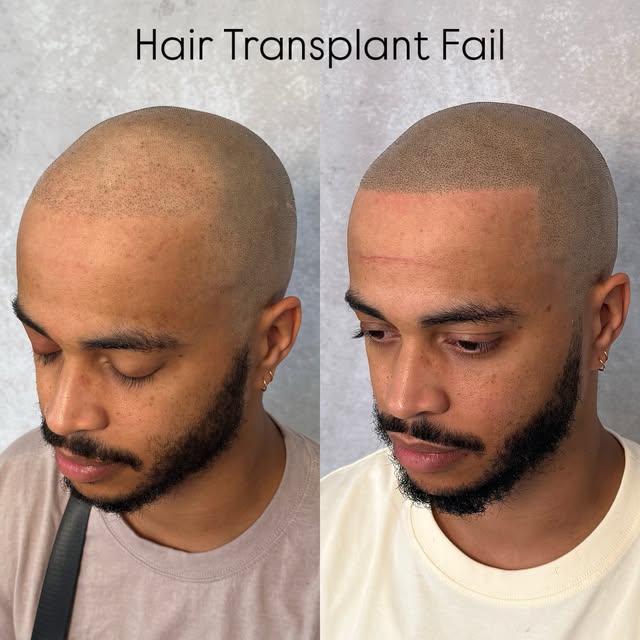 Failed hair transplant, swipe to see scar work ⬅️ @folicule 8 on the top 10 on the scar delusion @bi