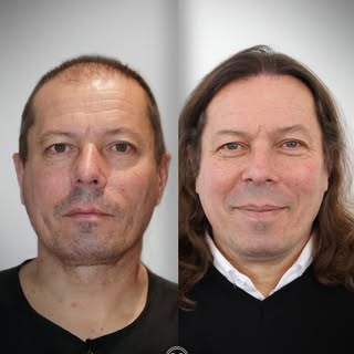 Grafts +5.800 | Para dhe Pas

Rezultatet më të mira për flokët dhe mjekrën tuaj me Murat Makascı 💫
