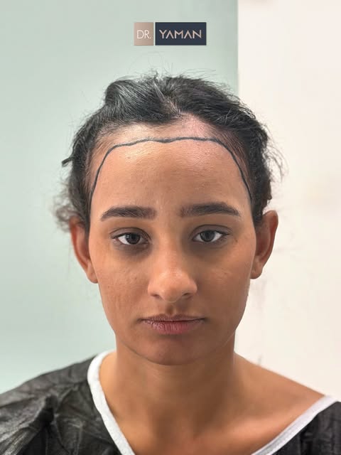 A natural-looking hairline starts with precise and thoughtful design. It is one of the most
importan
